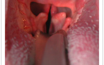 Paralisi della laringe